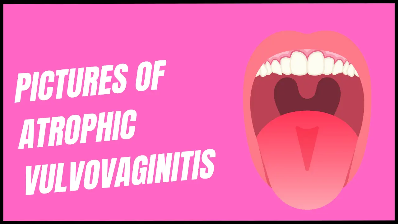 Pictures of atrophic vulvovaginitis